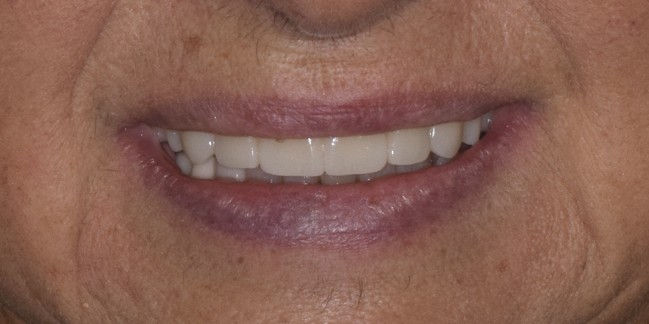Upper Arch Rehabilitation — after treatment