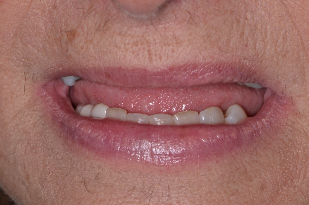 Upper Arch Rehabilitation — before treatment