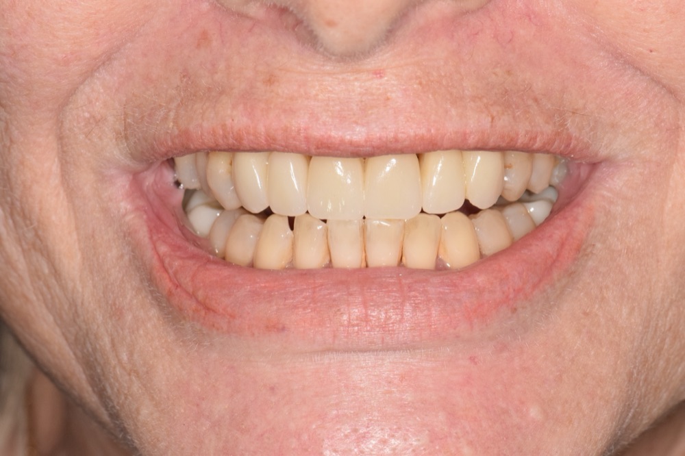 Anterior Implant Bridge — after treatment