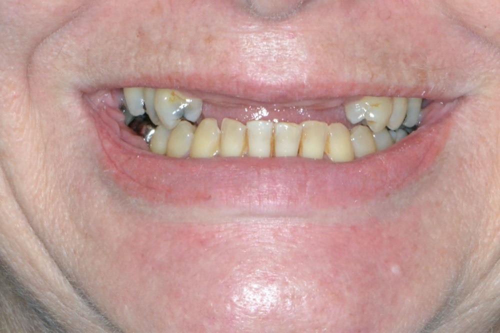 Anterior Implant Bridge — before treatment