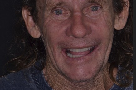 Same-Day Teeth — after treatment