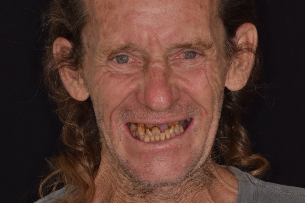 Same-Day Teeth — before treatment