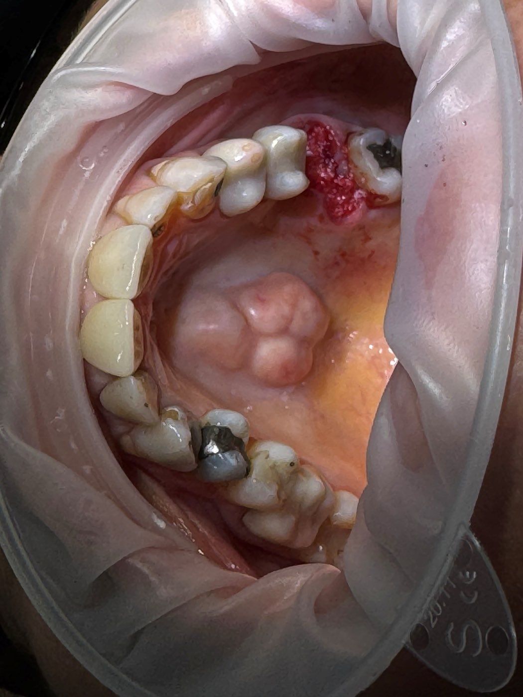Intraoral view of an extraction site prepared for grafting