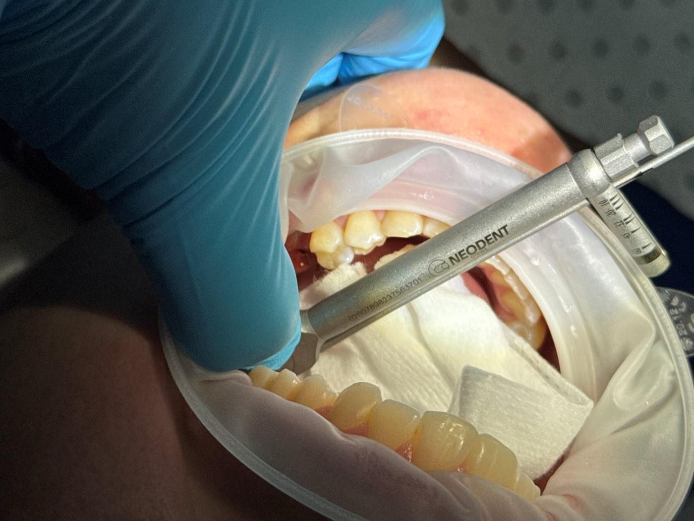 Neodent handpiece in use during implant site preparation