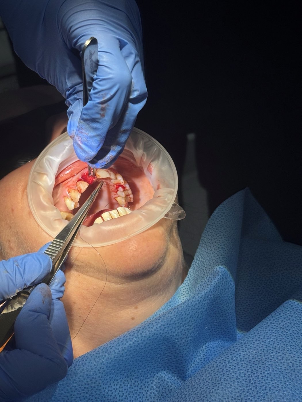 Atraumatic extraction and suturing on a live patient during the course