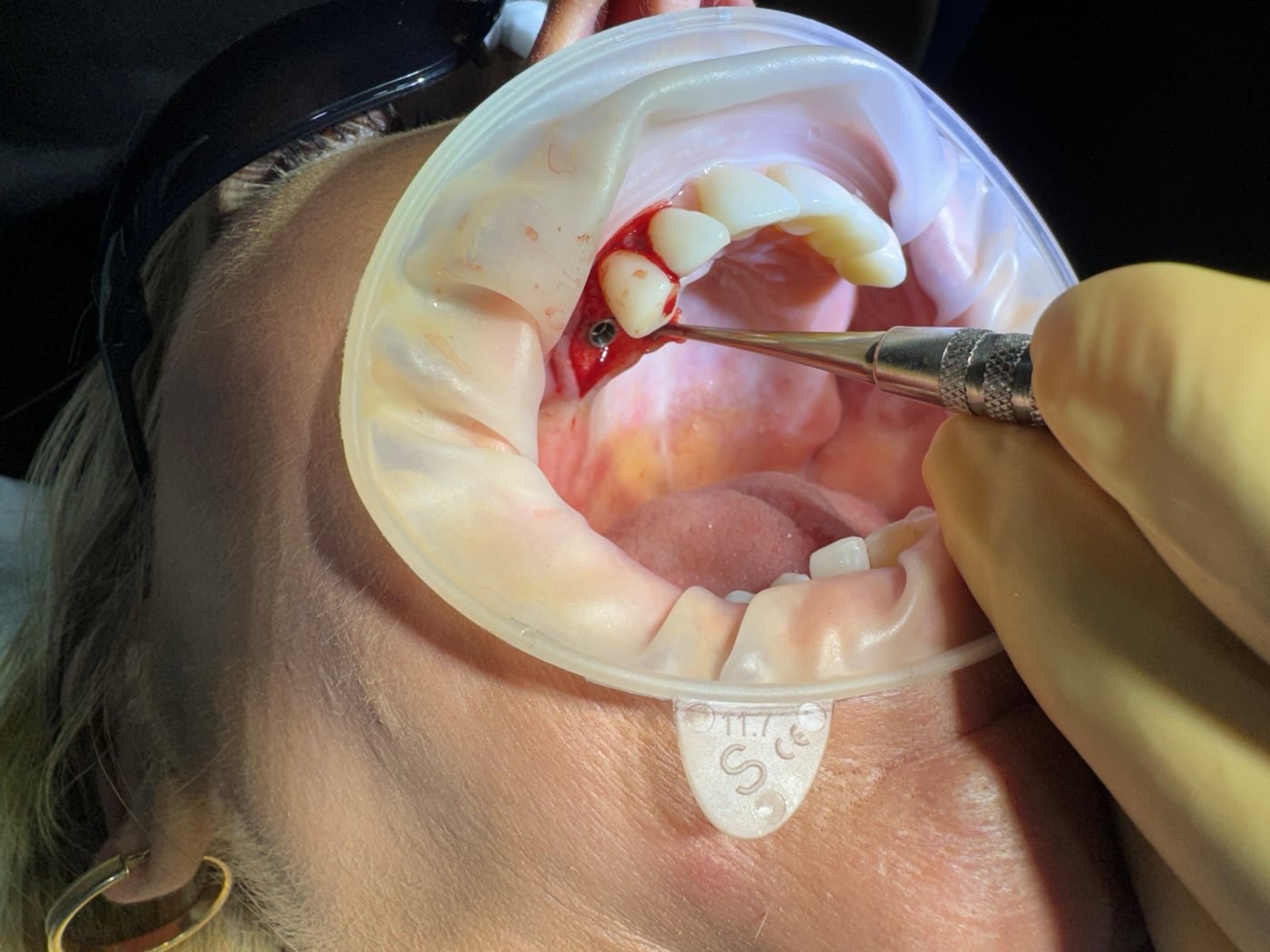 Implant placed in the upper arch during a course case