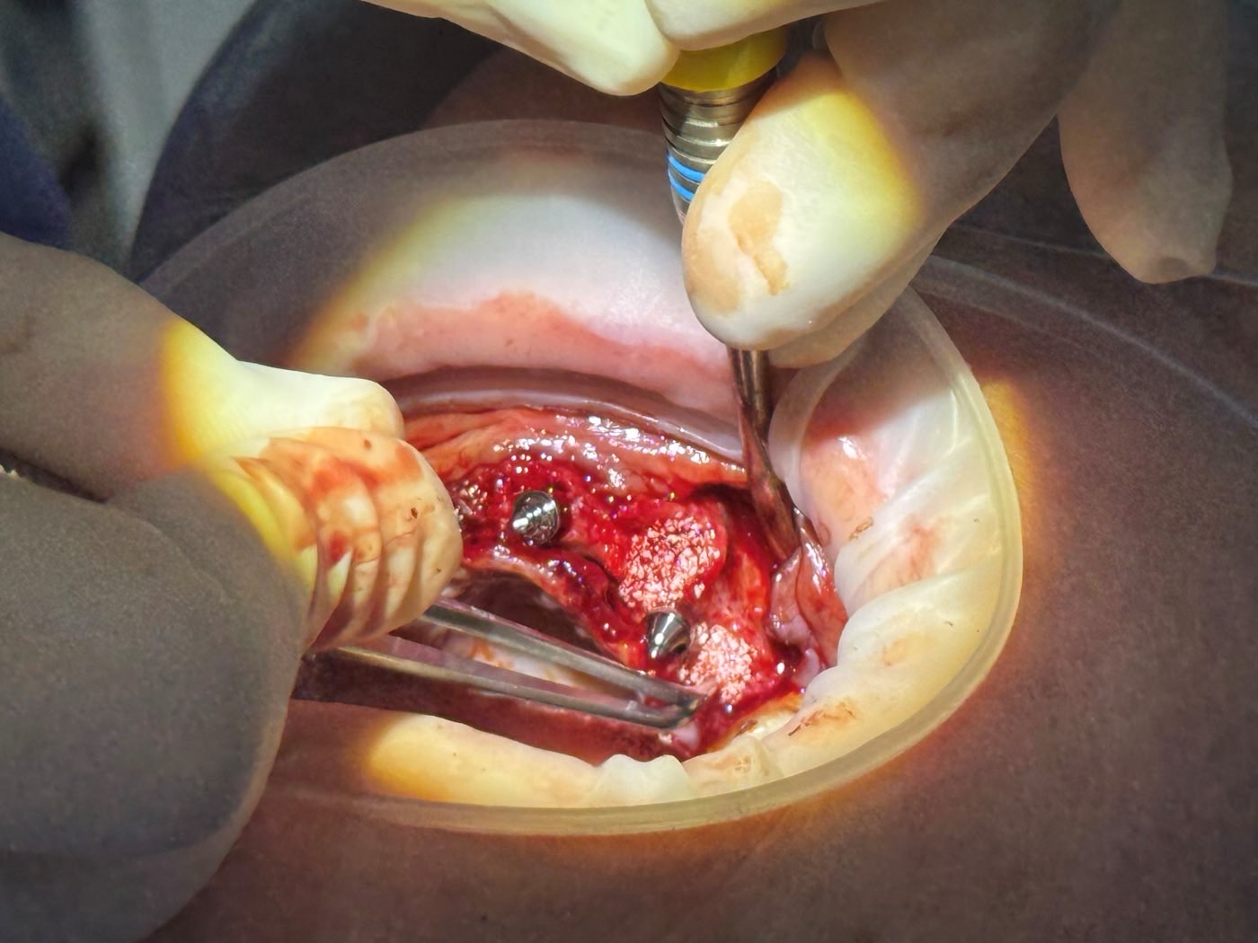Implants placed in an open surgical field during advanced surgery