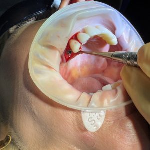 Diploma in Dental Implantology (EduQual Level 7)